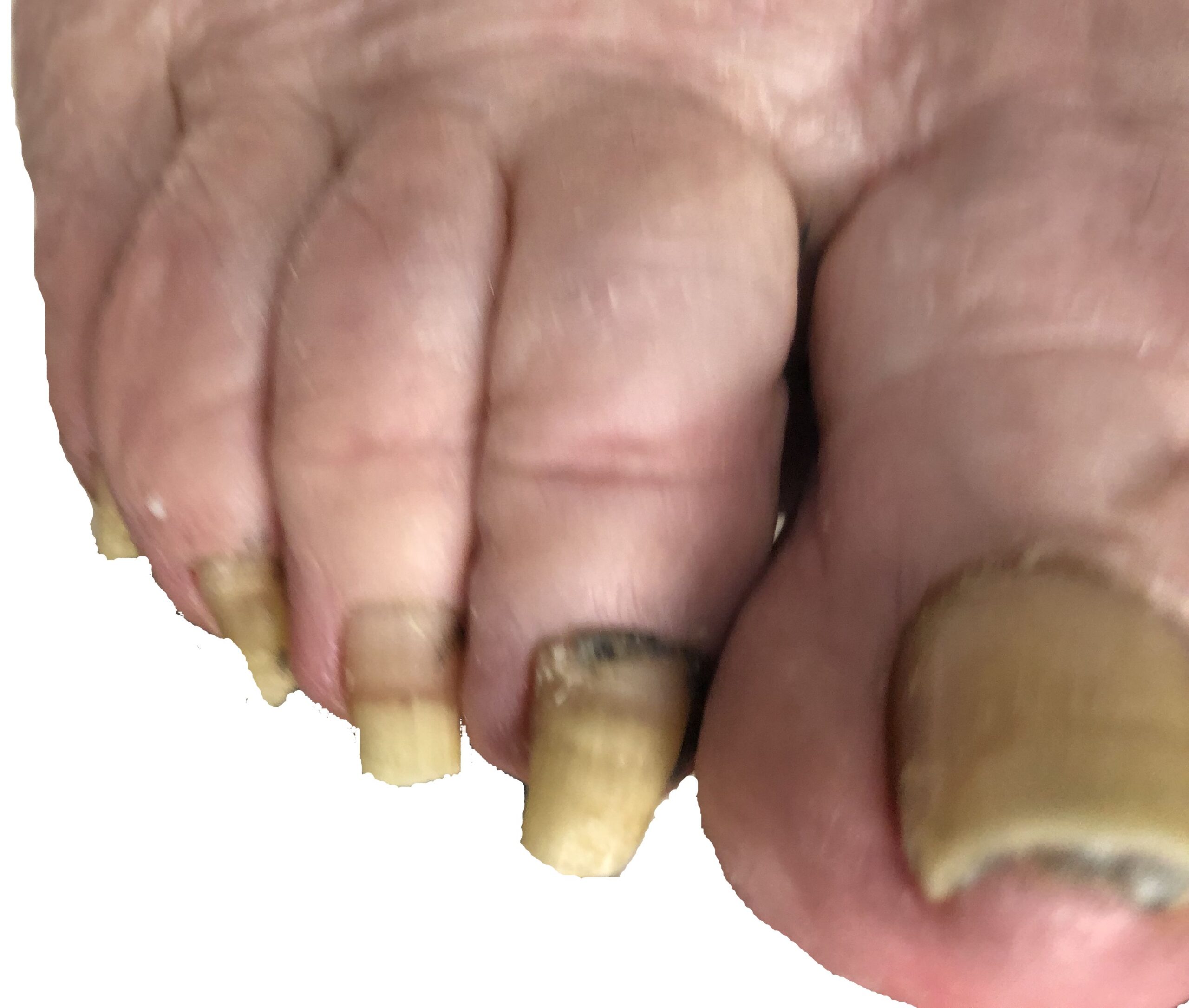 Thick, unmanageable toenails