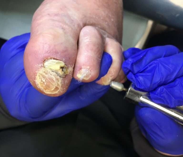 The Best Fungal Nail Treatments: Why ToeFX Stands Out