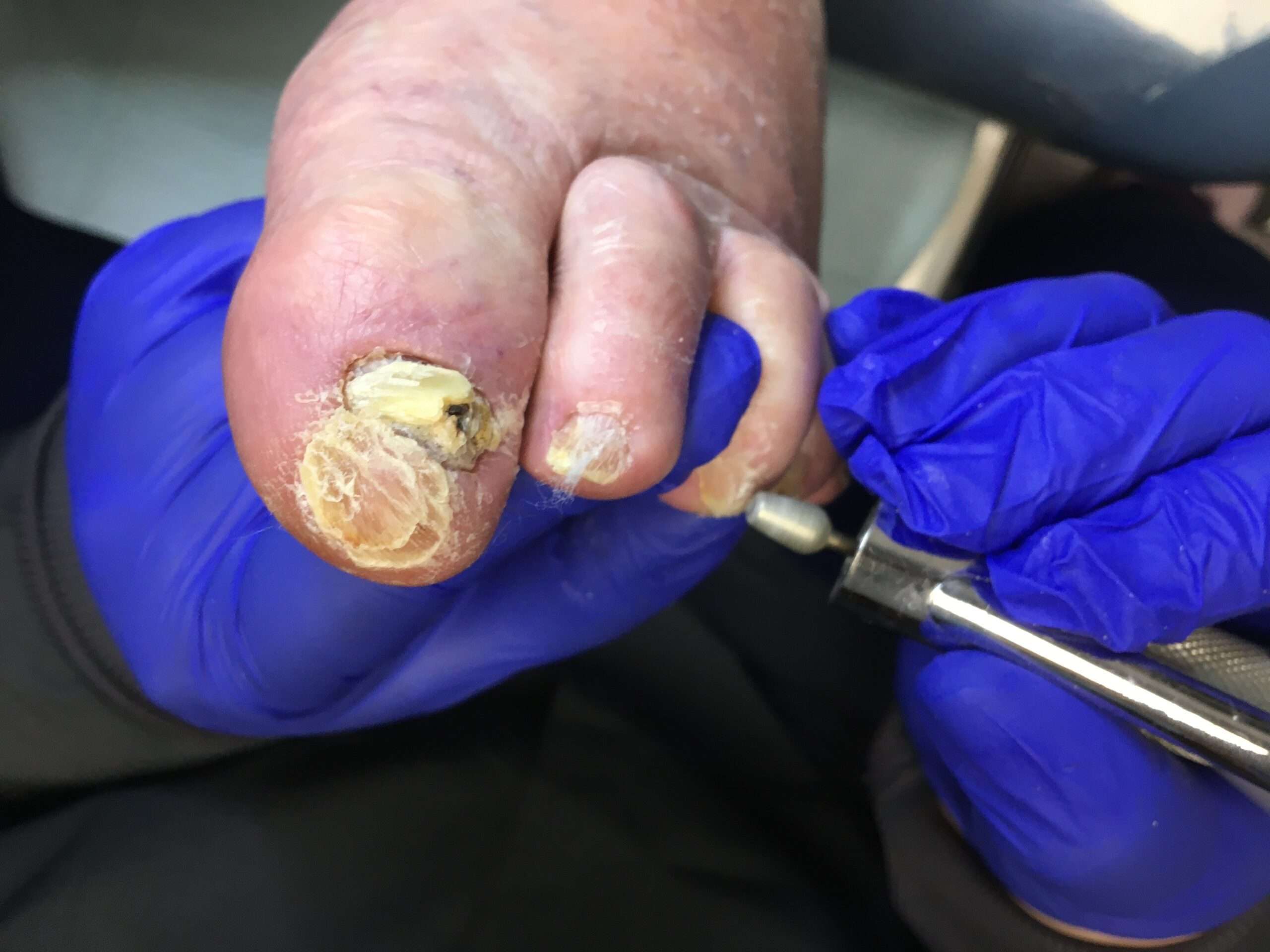 Geriatric Foot Care