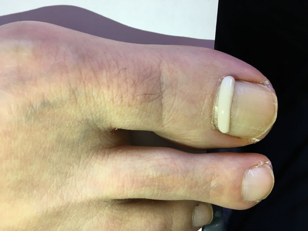 Onyfix for ingrow toenail