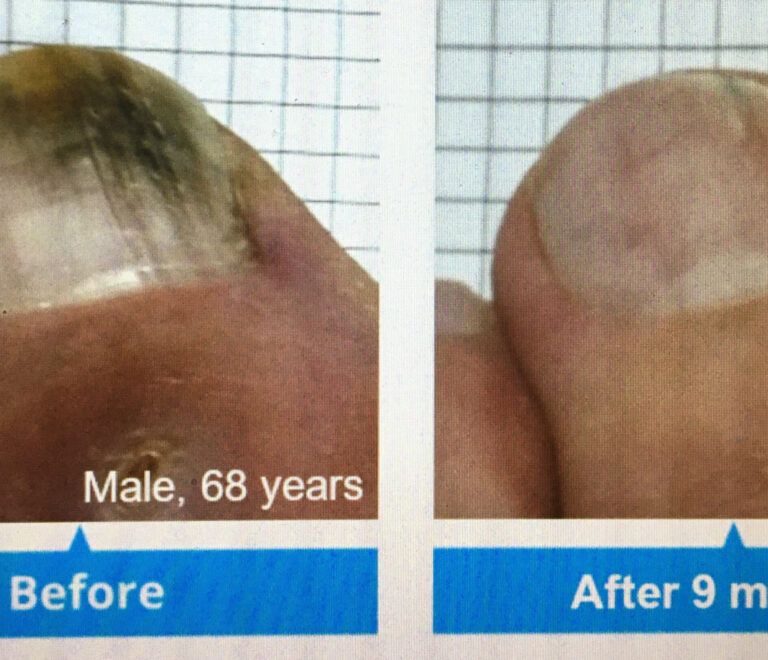 Fungal Toenails: One Discover Fast, Effective Treatment with ToeFX ClearToe Light Therapy!