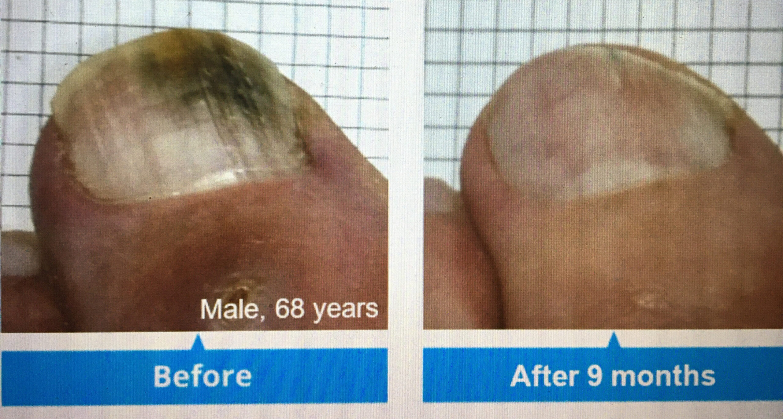 Fungal foot care